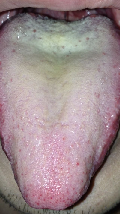 艾滋病舌头图片(56)