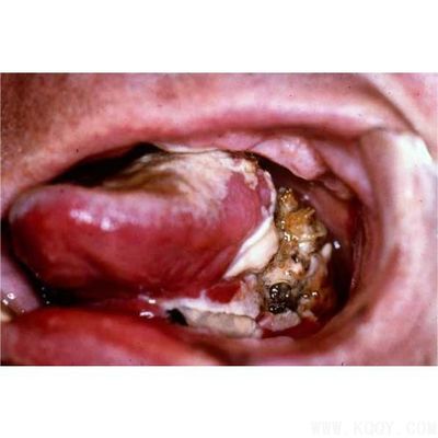 口腔癌的早期症状图(51)