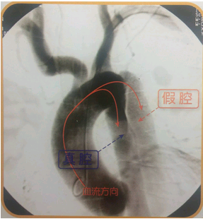 比如:胸片可以看到主动脉球扩大,纵膈增宽,但胸片不能作为夹层的确诊