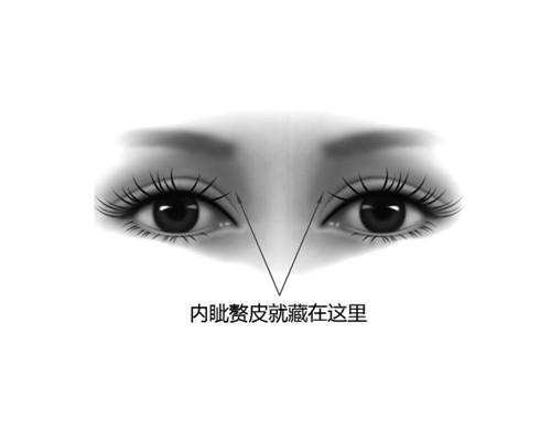 內(nèi)眥贅皮 (23)