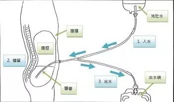 尿毒症腹膜透析病人为什么容易得疝?还能做手术吗?