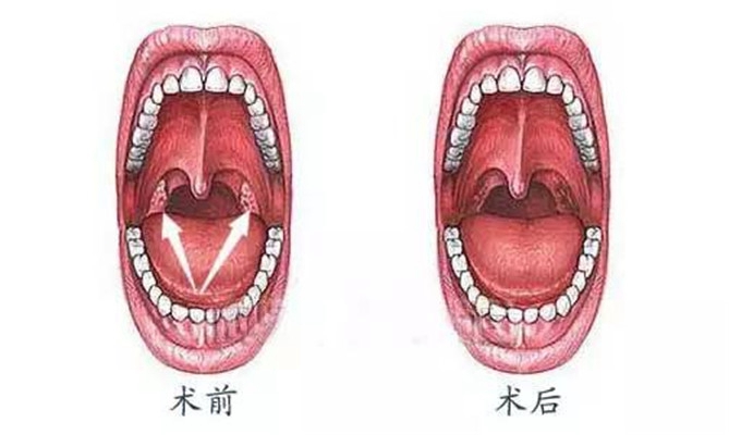 舌根部淋巴滤泡增生 (50)