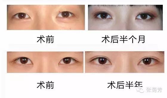 为什么割双眼皮后有人恢复快,有人恢复慢?_张