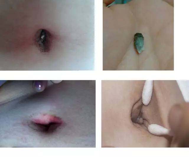 肚脐里的沉香到底该不该清洗?
