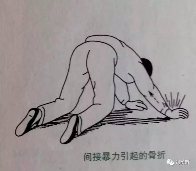 骨折是怎样发生的?_刘东昕