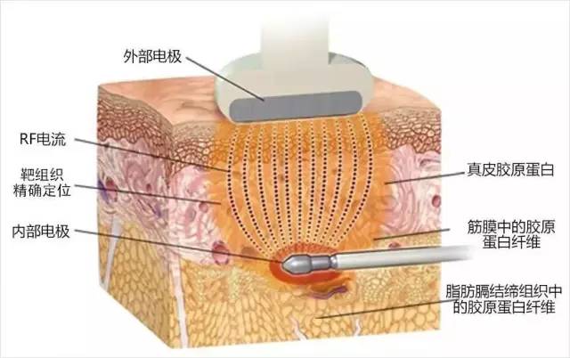 "射频"这个看似陌生的词汇也逐渐为人们所熟知,由于其治疗过程舒适