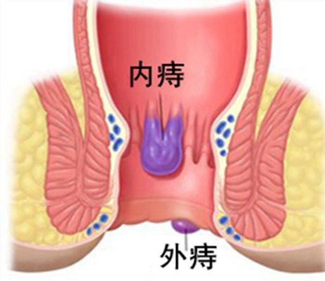 痔瘡圖片大全 (3)