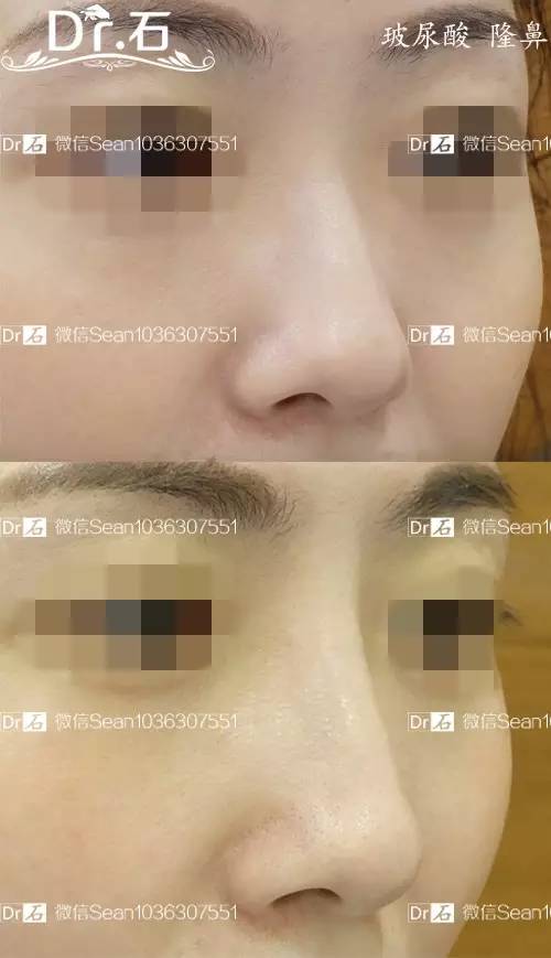 注射隆鼻是将玻尿酸或自体脂肪以填充物的方式注入于鼻部,注射后