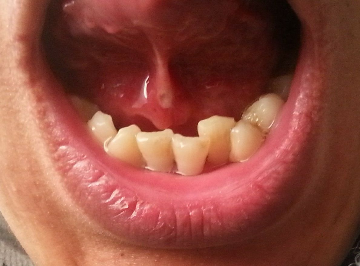 舌癌的早期症状图片 (36)