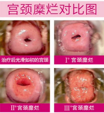 子宮糜爛的癥狀圖 (13)