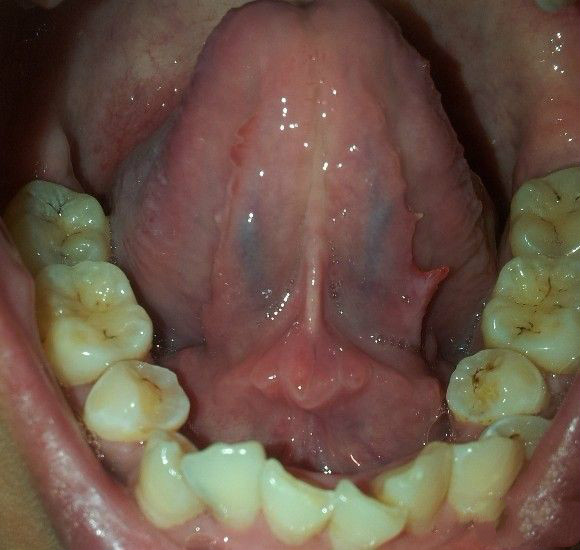 口腔尖銳濕疣 (25)
