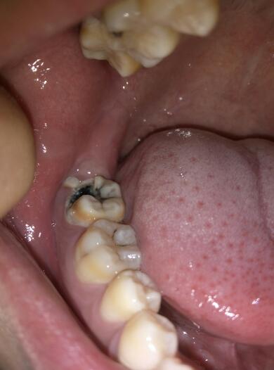 虫牙(4)