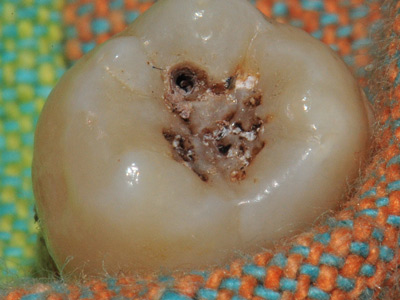虫牙(4)