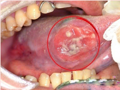 輕微舌癌圖片 (28)
