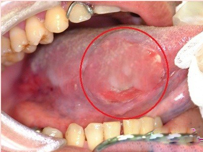 輕微舌癌圖片 (36)