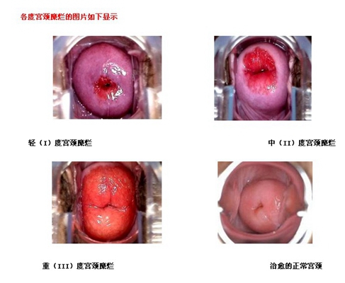 子宮糜爛的癥狀圖 (11)