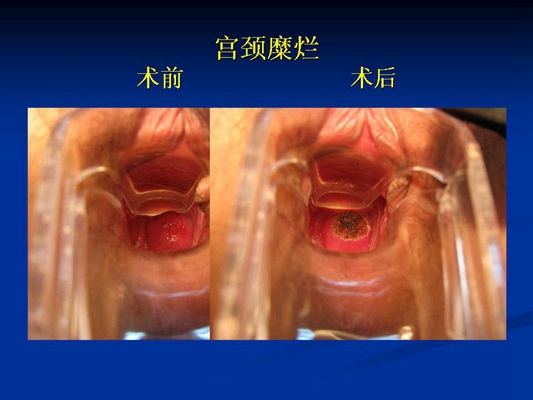 子宮糜爛的癥狀圖 (14)
