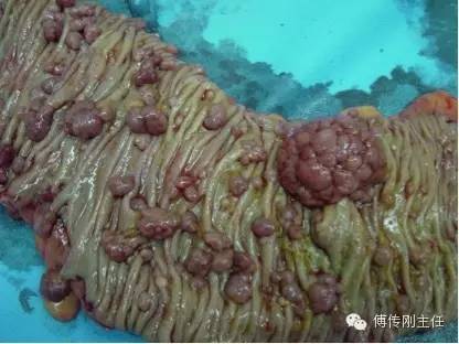 家族腺瘤性息肉病患者的大肠上分布着密密麻麻大小不等的息肉