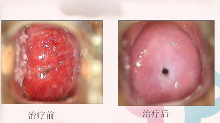 宫颈炎图片_宫颈炎症状表现图片大全_有来医生