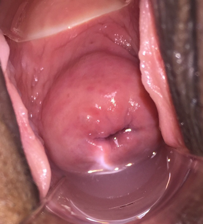 宮頸糜爛2度 (1)
