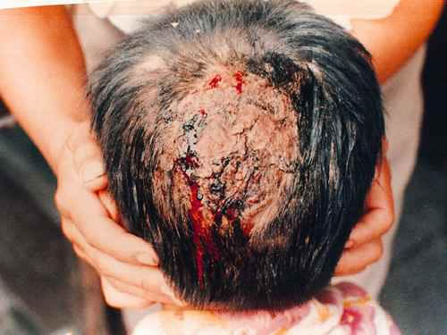 头皮癣早期症状图片 (45)