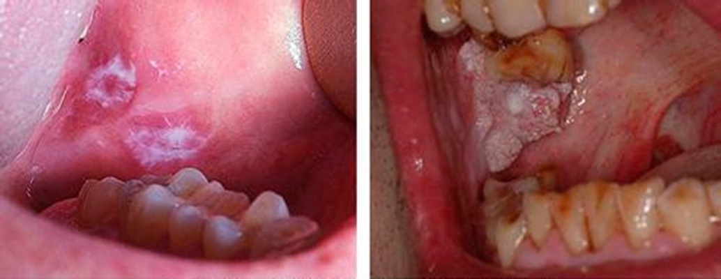 口腔白斑 (49)
