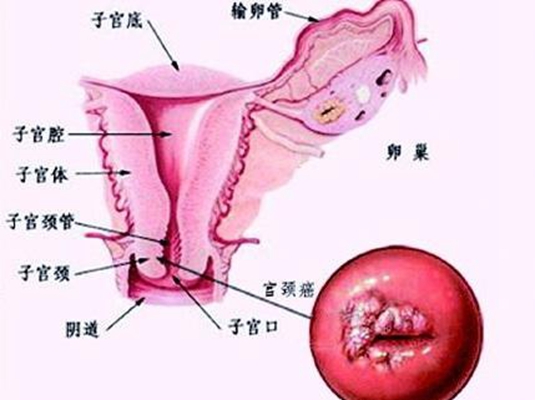 宫颈癌的早期症状图片7