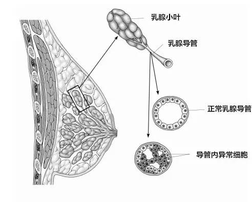 六种类型的乳腺癌你了解多少