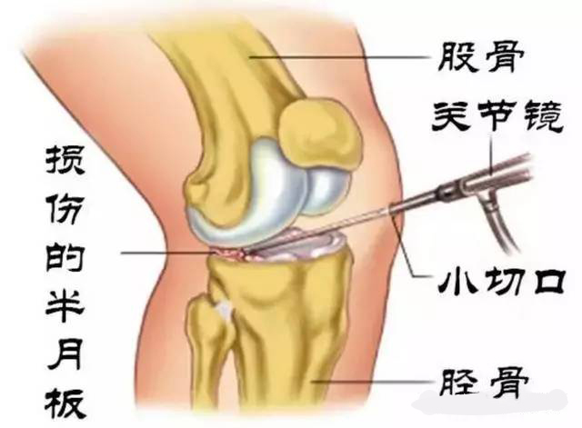 半月板损伤治疗:保守or手术?