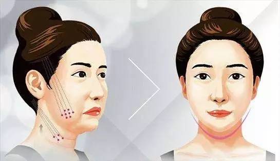 PPDO线雕提升和手术除皱、注射填充区别在哪