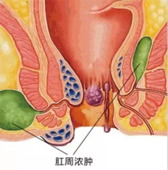 肛周脓肿到底是个什么东西?西安东大肛肠医院讲解!