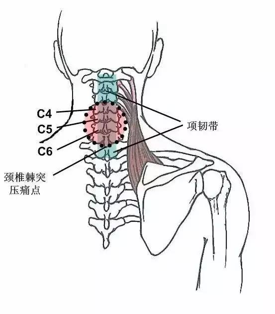 颈椎棘突压痛多见于棘上韧带,亦称项韧带,压痛常见于颈椎3,4,5,6