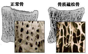 骨质疏松性脊柱压缩骨折怎么办?