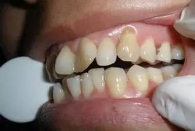 儿童牙齿矫正需要拔牙吗?