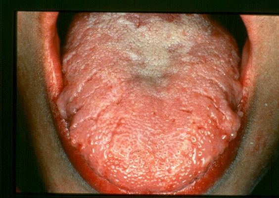 舌炎的症状图片