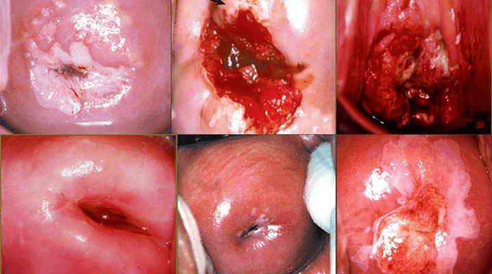 宫颈癌图片 (40)