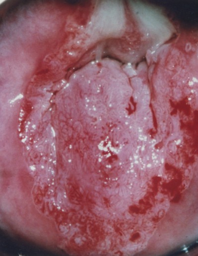 宮頸癌圖片 (24)