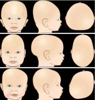 会在宝宝的外貌上留下缺憾——头部两侧的五官,脸颊不对称,影响外观