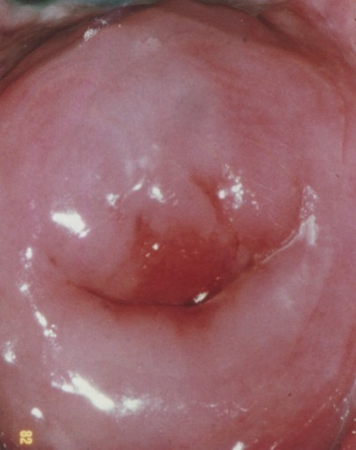 宮頸癌圖片 (25)