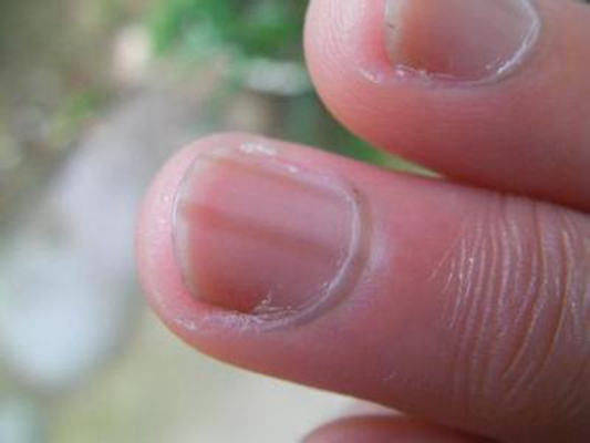 大拇指指甲上有竖纹 (46)