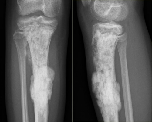 骨癌图片 (9)