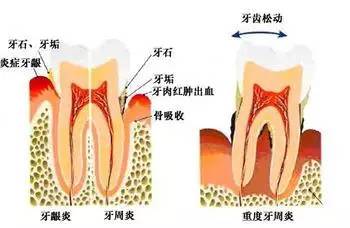 牙周疾病是造成老年人牙齿丧失的