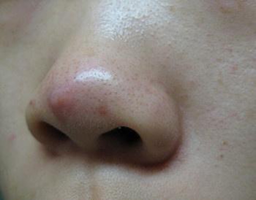 鼻子长螨虫症状图片(53)