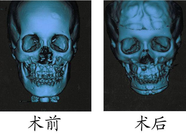 下颌整形