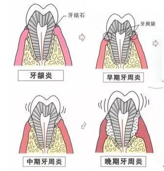 牙周疾病是造成老年人牙齿丧失的"罪魁祸首"