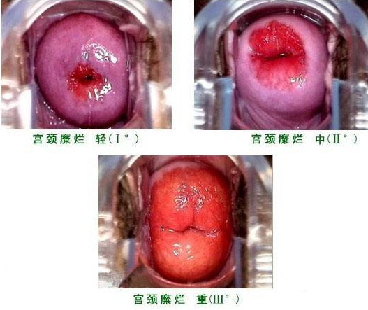 輕度宮頸糜爛 (6)