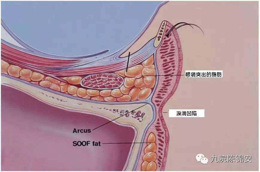 泪痕沟的形成原因及解决方法