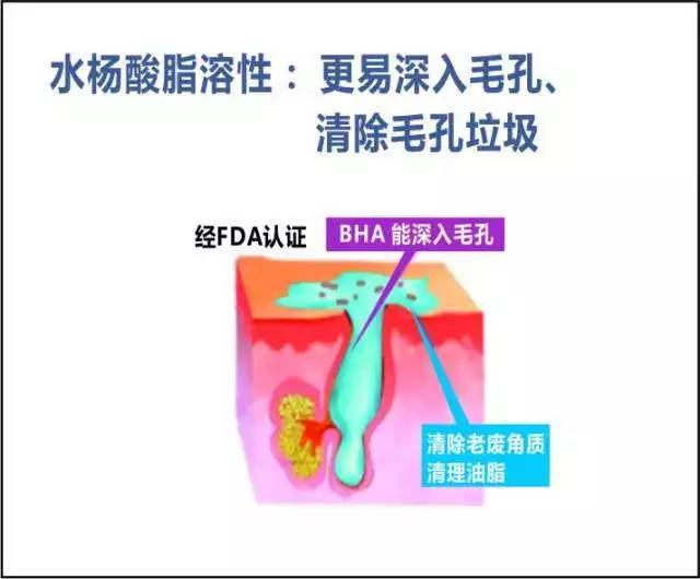 超分子水杨酸焕肤的作用_石成方_中华康网