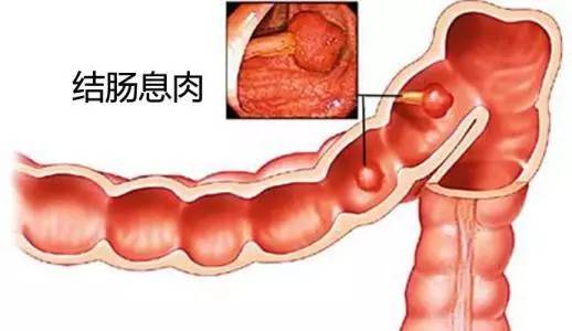 大便总不成形要注意,警惕是可能癌变的结肠息肉