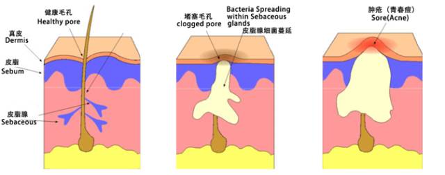 超分子水杨酸焕肤的作用_石成方_中华康网